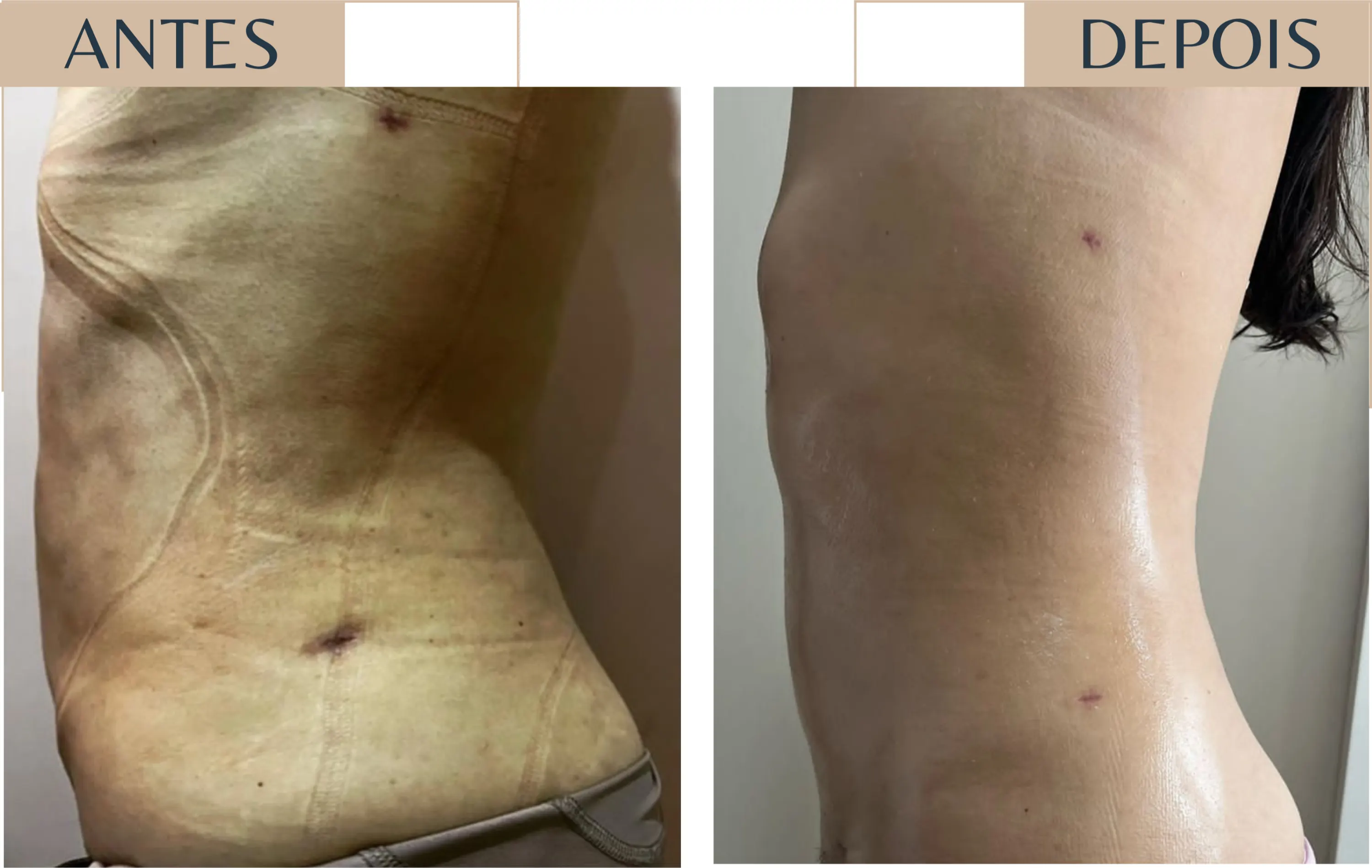 Antes e depois de paciente em pós-operatório, com redução de edema no abdome