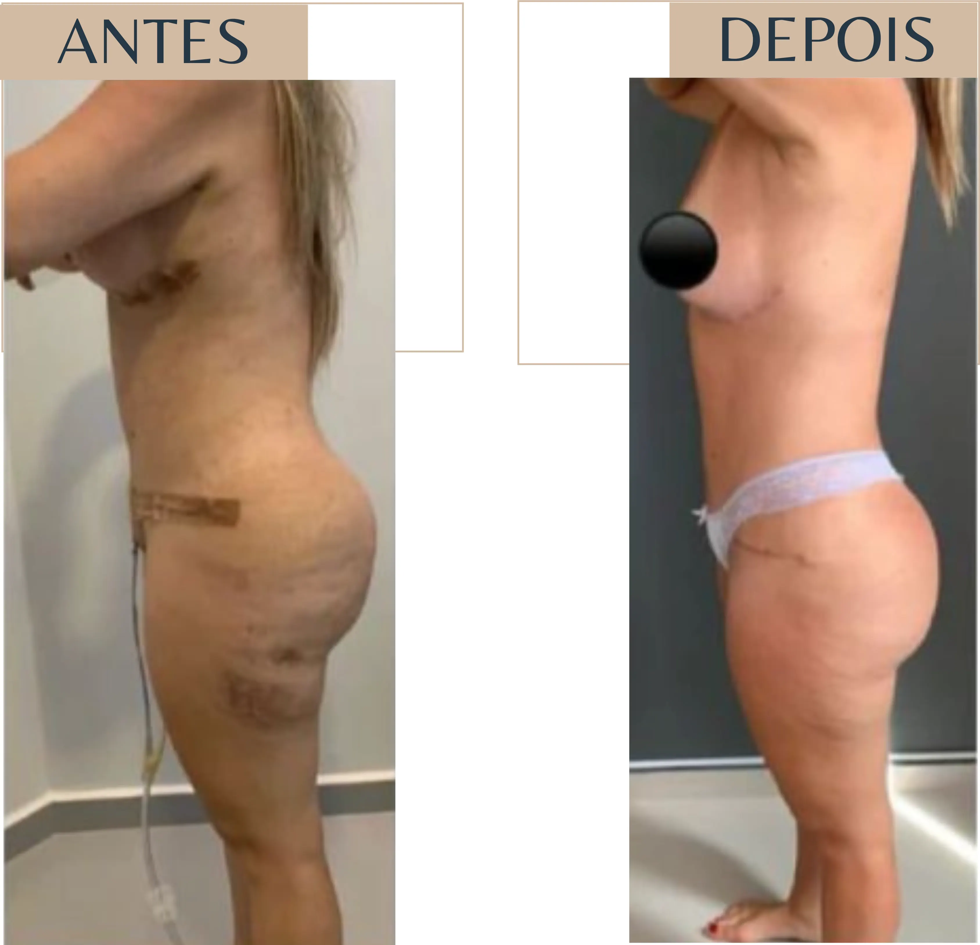 Antes e depois de paciente em pós-operatório de cirurgia plástica corporal