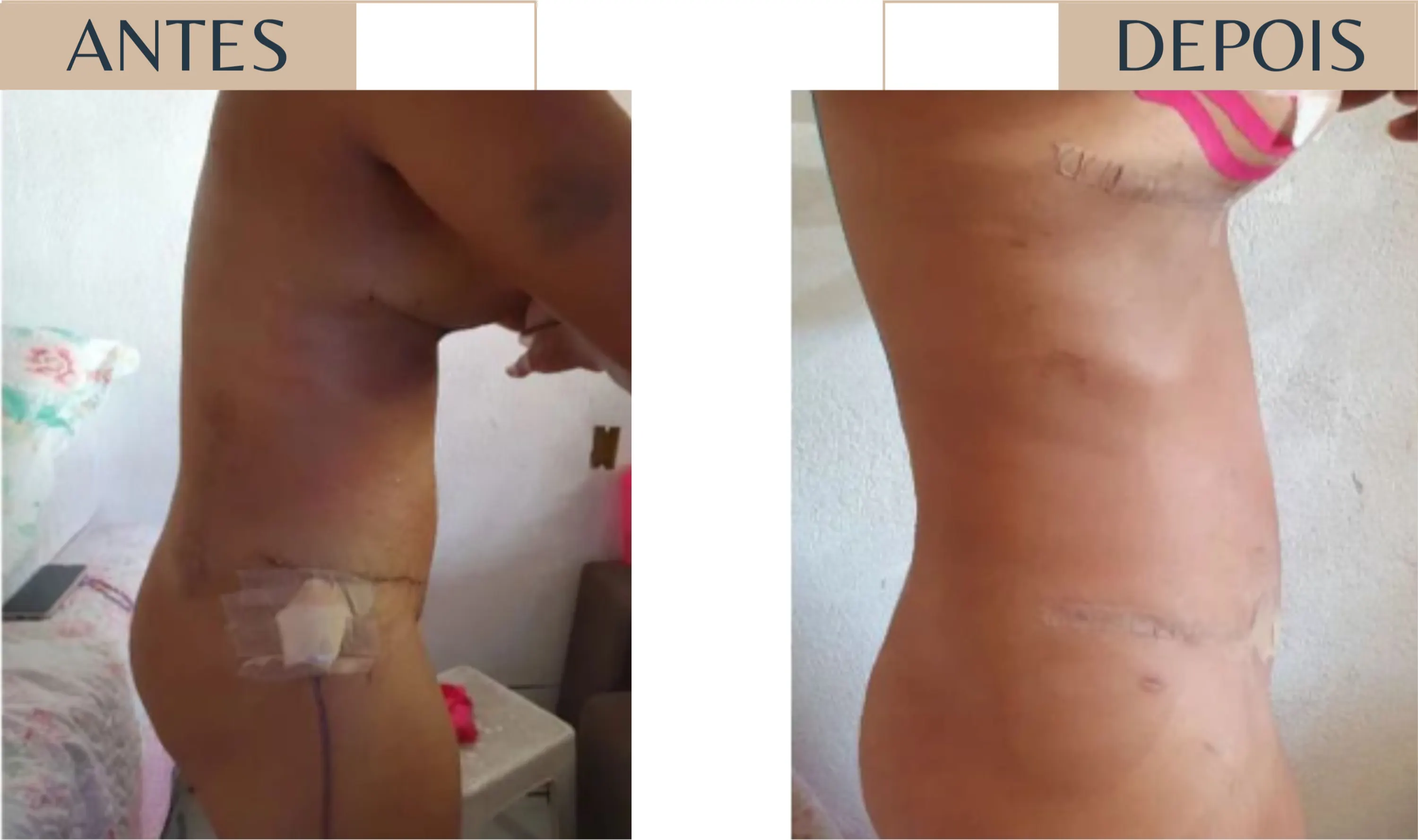Antes e depois de paciente em pós-operatório, com redução de edema e hematoma