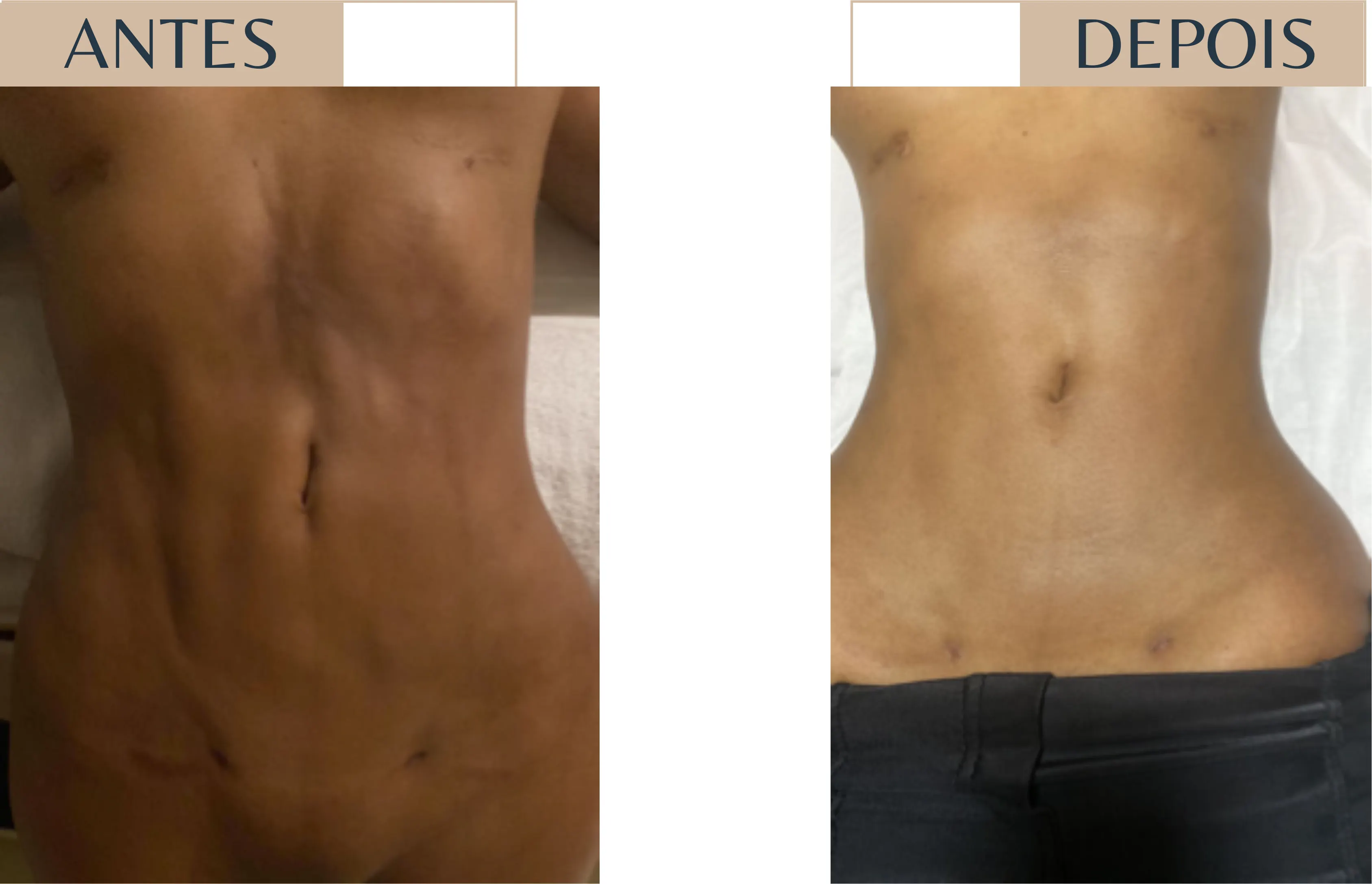 Antes e depois de paciente em pós-operatório, região abdominal