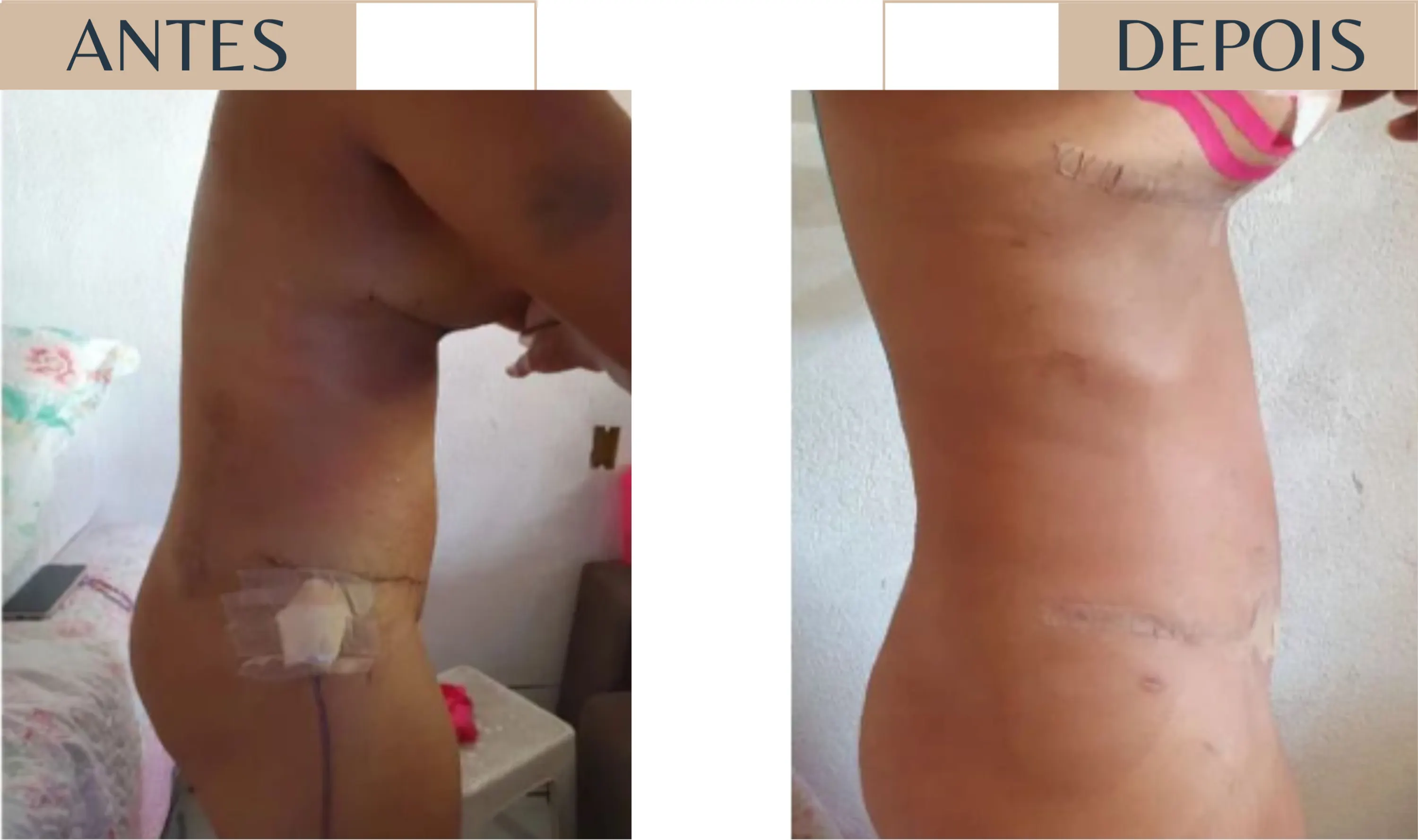 Antes e depois de paciente em pós-operatório, com evolução do edema