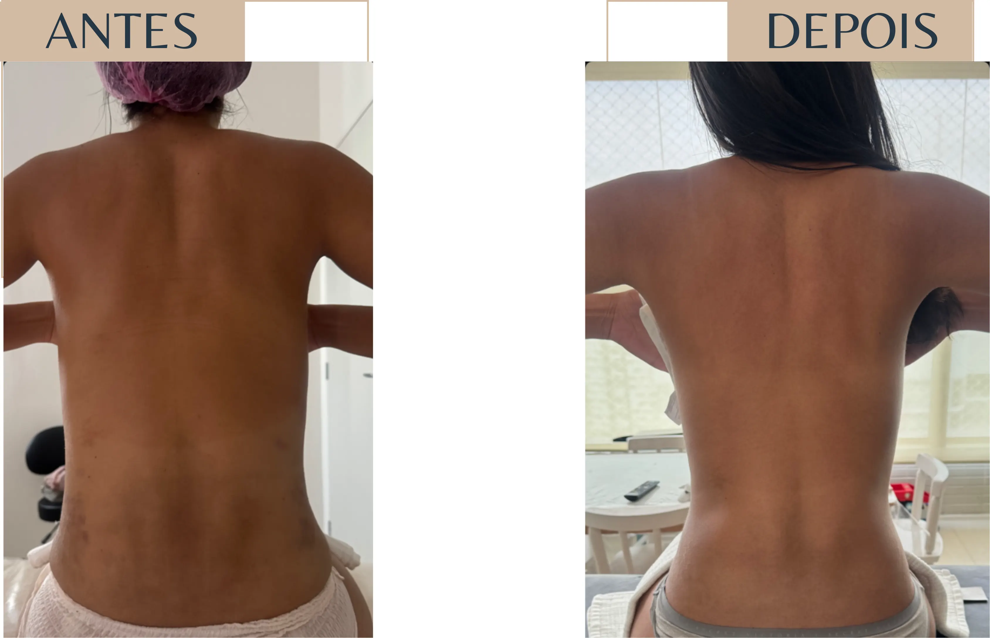 Antes e depois de paciente em pós-operatório, região dorsal
