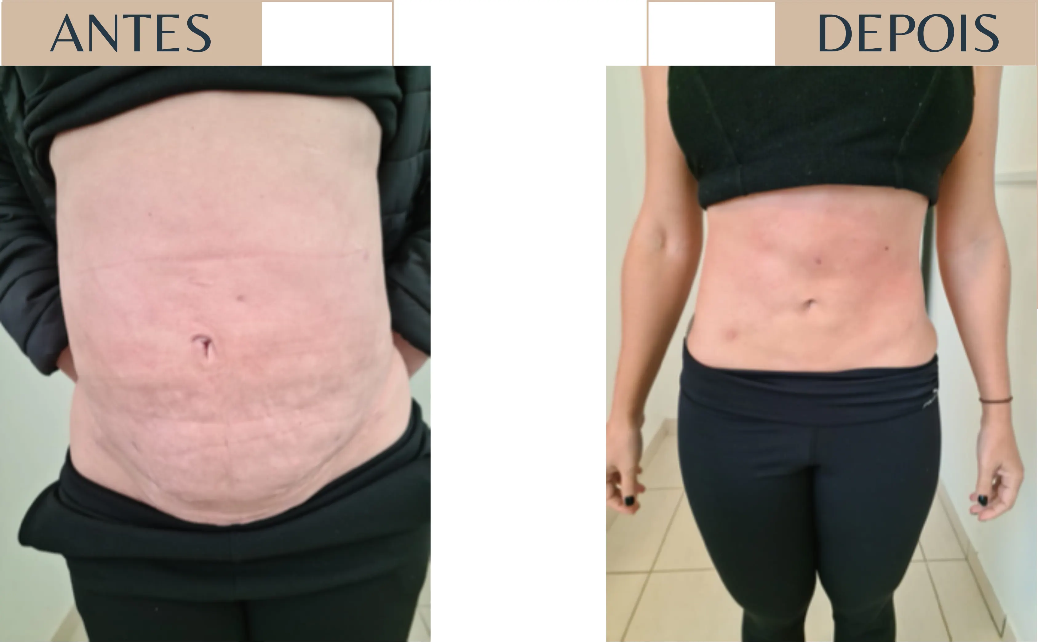 Antes e depois de paciente em pós-operatório, com redução de edema abdominal